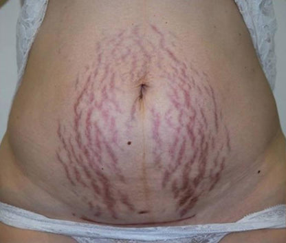 SlimAngel: Doctor-Recommended Body Detoxifier & Fat Burner Bodysuit - Pretty Little Wish.com